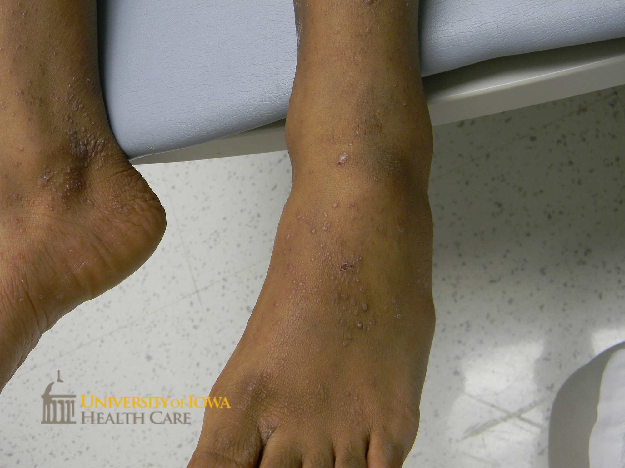 Pink to violaceous polygonal papules with overlying white scale on the lower legs. (click images for higher resolution).